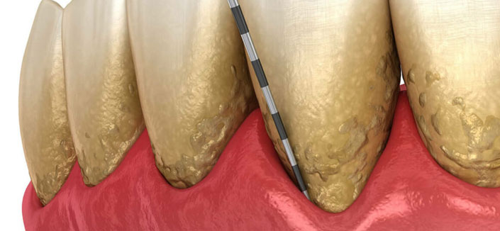 Gum Disease Treatment