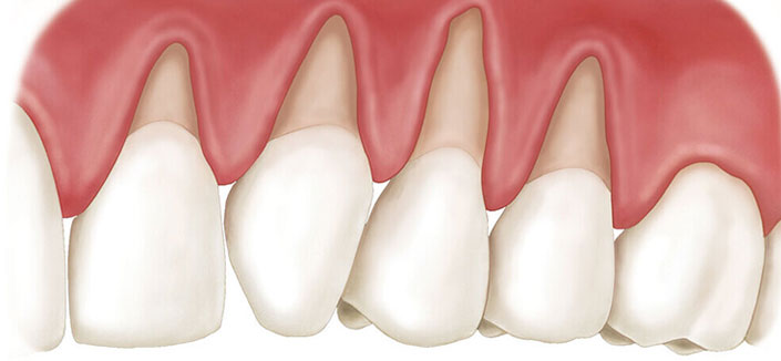Gum Recession Treatment