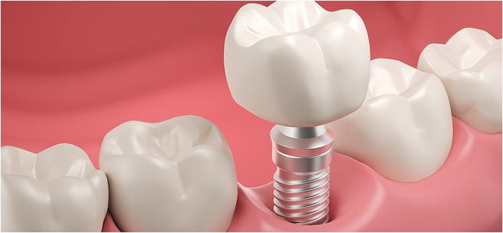 Dental Implants