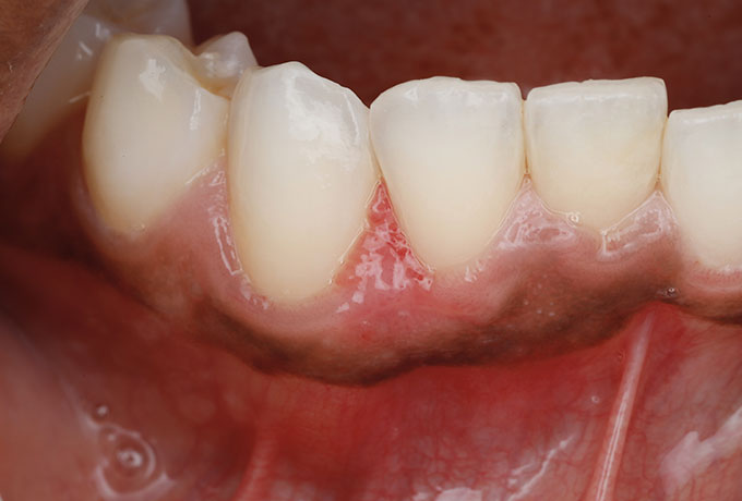 What a Soft Tissue Biopsy Involves