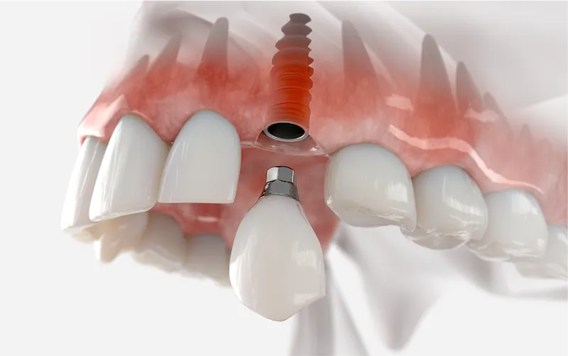 Advanced Options<br />
for Every Smile