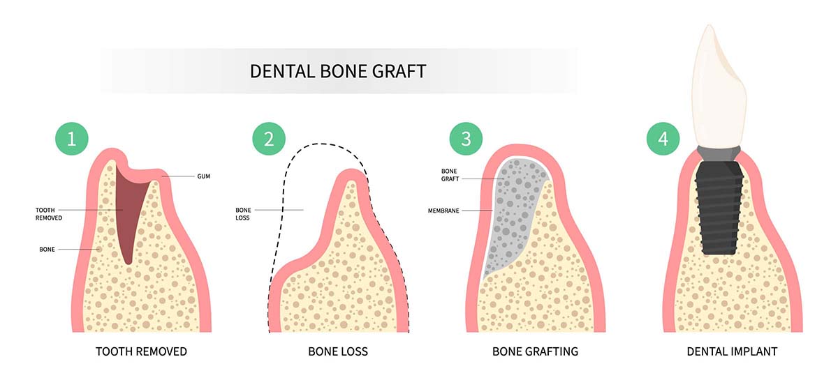 How Bone Grafting Works