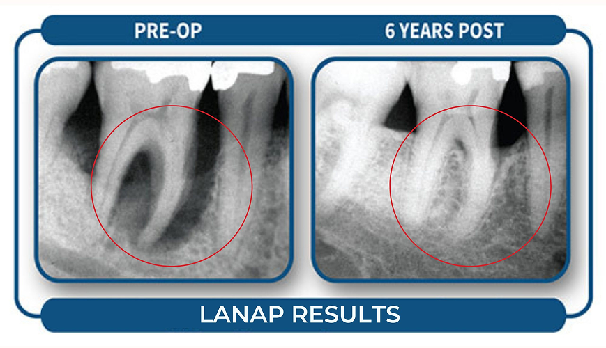 LANAP Results