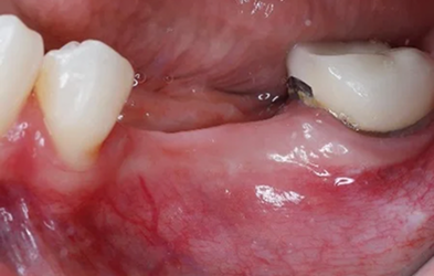 Bone Graft Surgery Post Op