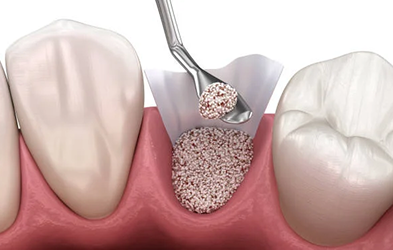 Extraction and Socket Graft Post Op
