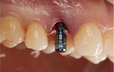 Implant Placement Post Op