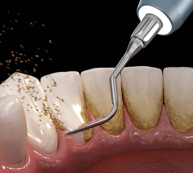 How Scaling & Root Planing Helps