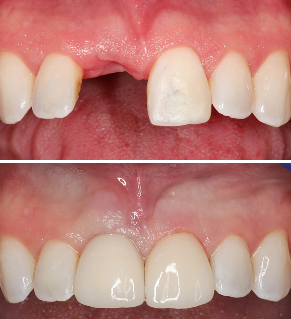 What Are<br />
Dental Implants?